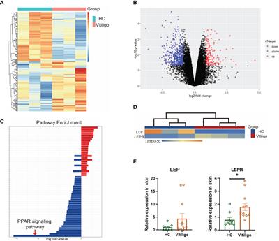 Leptin deficiency in CD8+ T cells ameliorates non-segmental vitiligo by reducing interferon-γ and Granzyme B